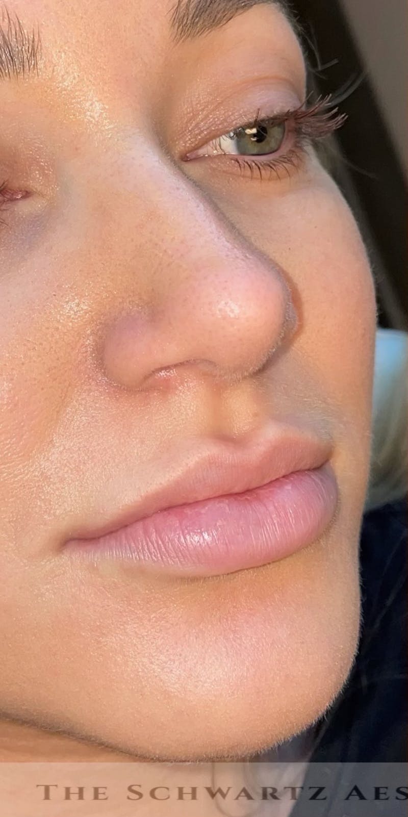 Lip Enhancement Before & After Gallery - Patient 377128 - Image 3