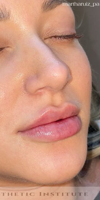 Lip Enhancement Before & After Gallery - Patient 377128 - Image 4