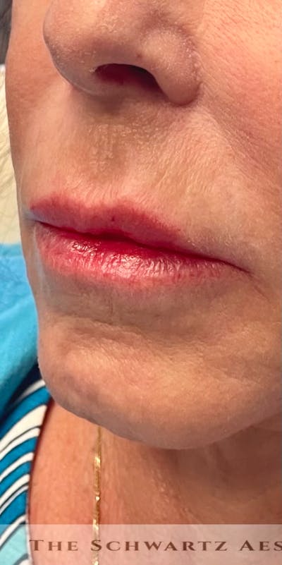 Dermal Fillers Before & After Gallery - Patient 101768 - Image 1