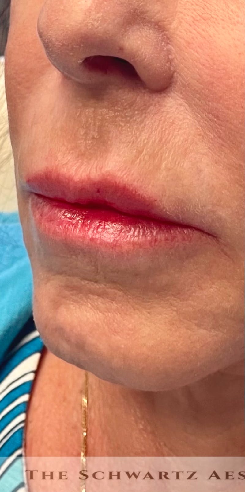 Dermal Fillers Before & After Gallery - Patient 101768 - Image 1