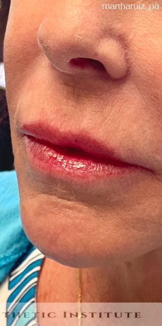 Chin Filler Before & After Gallery - Patient 411539 - Image 2