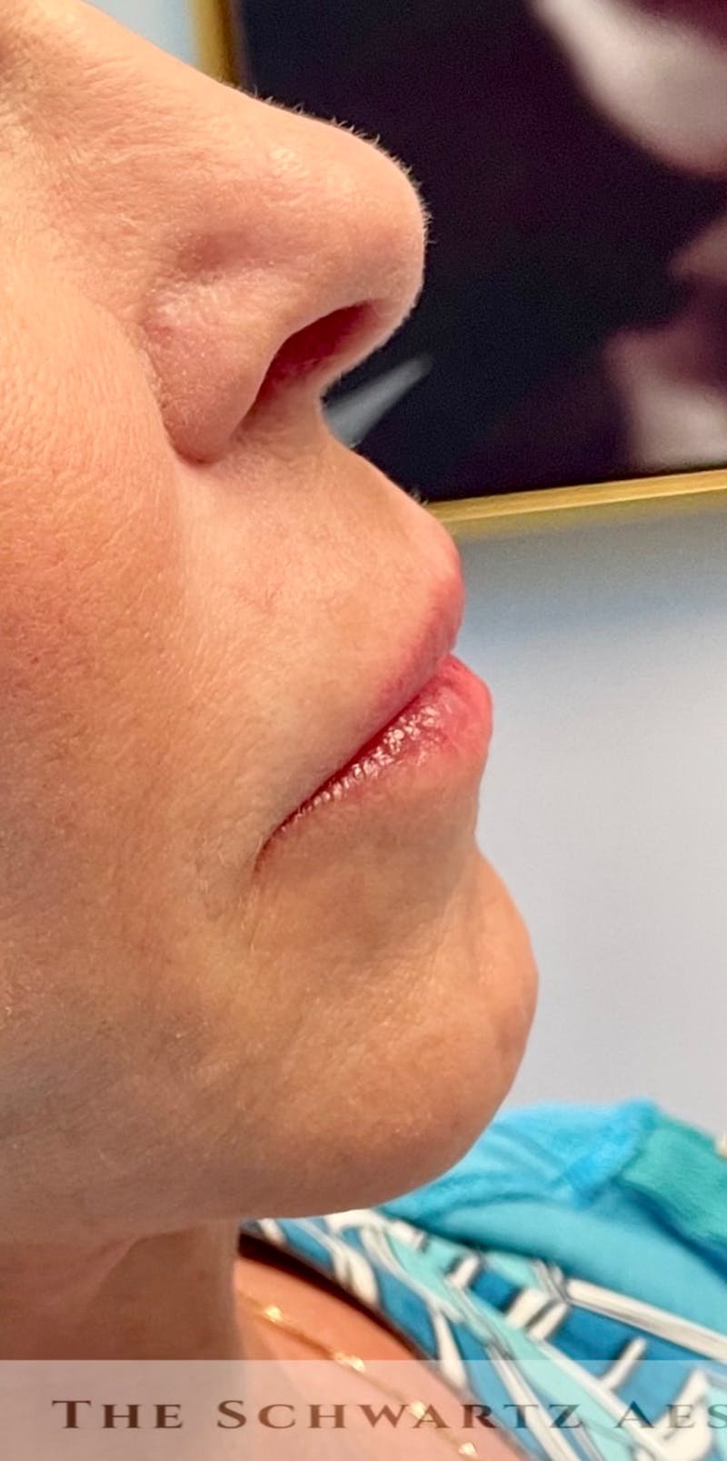 Dermal Fillers Before & After Gallery - Patient 101768 - Image 3