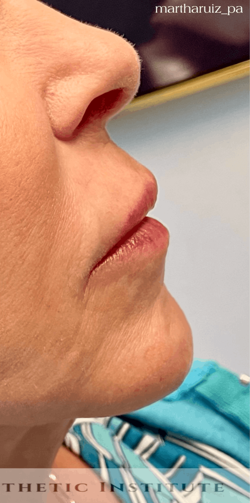 Dermal Fillers Before & After Gallery - Patient 101768 - Image 4