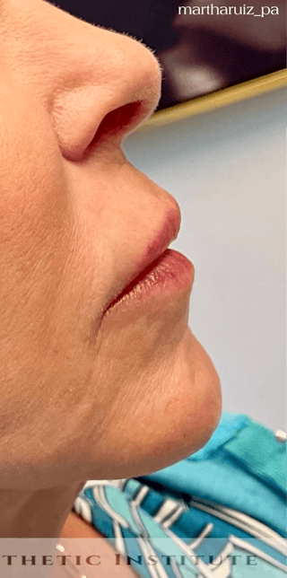 Chin Filler Before & After Gallery - Patient 411539 - Image 4