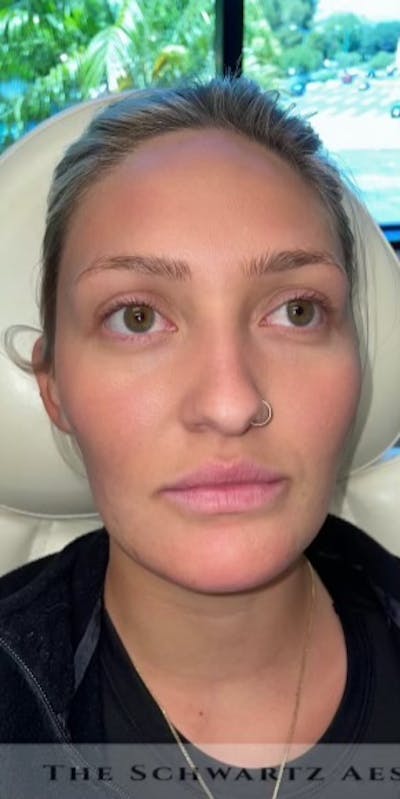 Chin Filler Before & After Gallery - Patient 385684 - Image 1