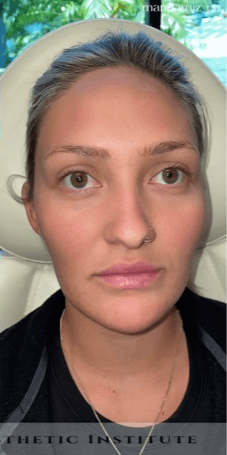 Chin Filler Before & After Gallery - Patient 385684 - Image 2