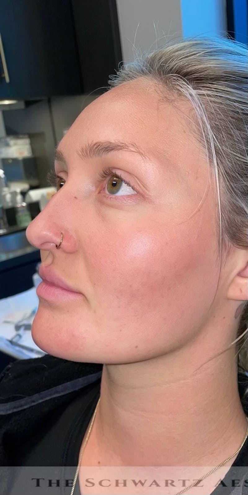Chin Filler Before & After Gallery - Patient 385684 - Image 3
