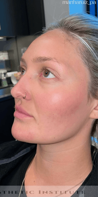 Chin Filler Before & After Gallery - Patient 385684 - Image 4