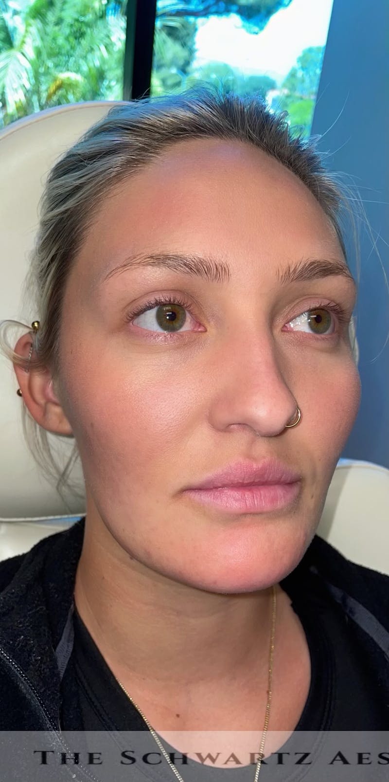 Chin Filler Before & After Gallery - Patient 385684 - Image 5