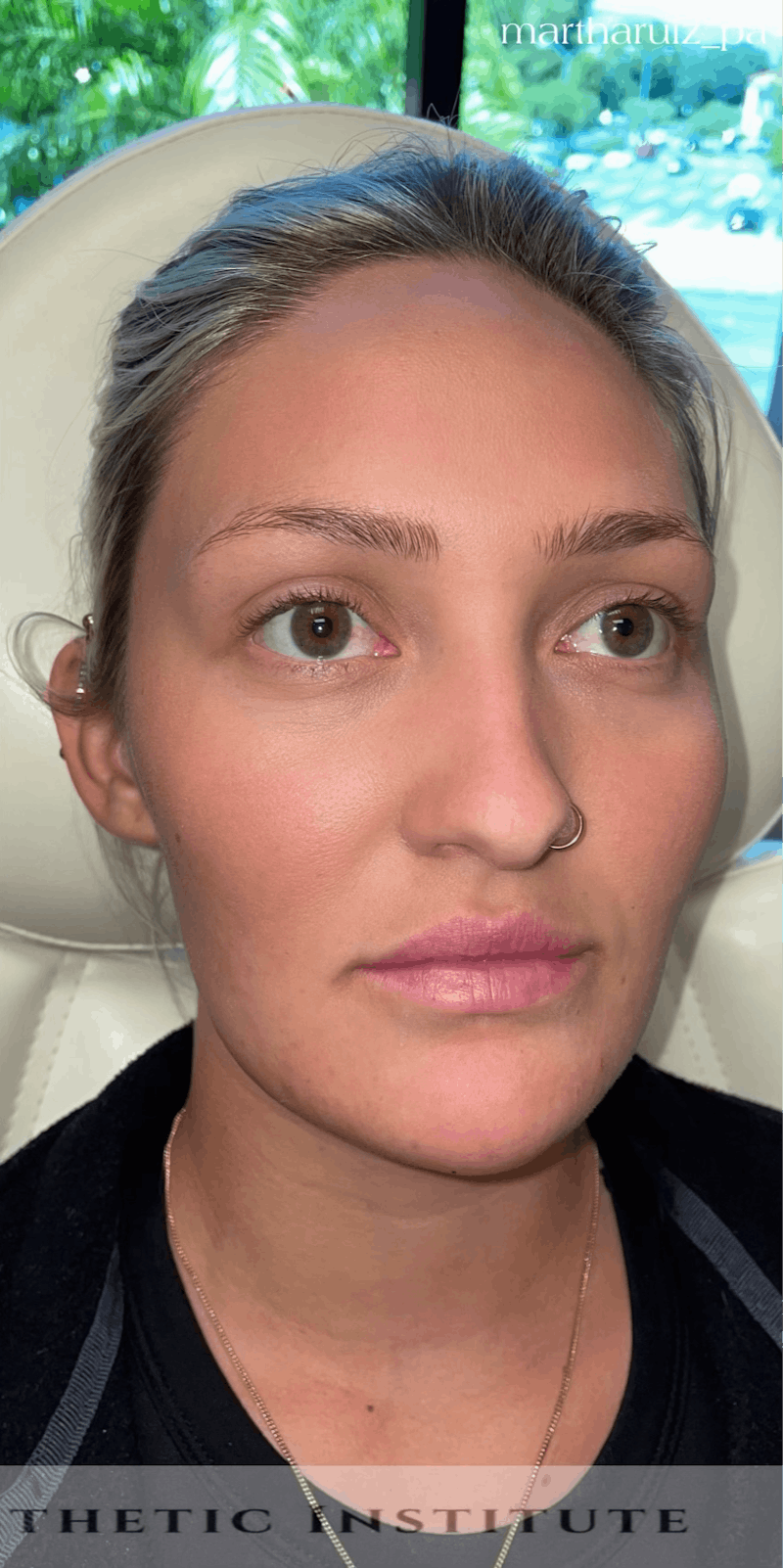 Chin Filler Before & After Gallery - Patient 385684 - Image 6
