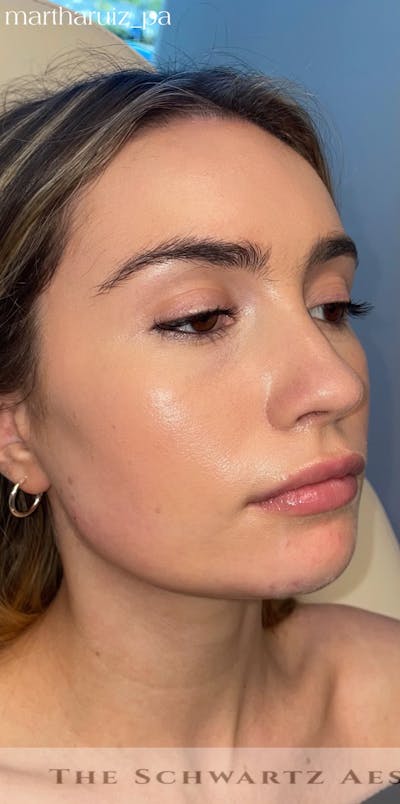 Chin Filler Before & After Gallery - Patient 428654 - Image 1
