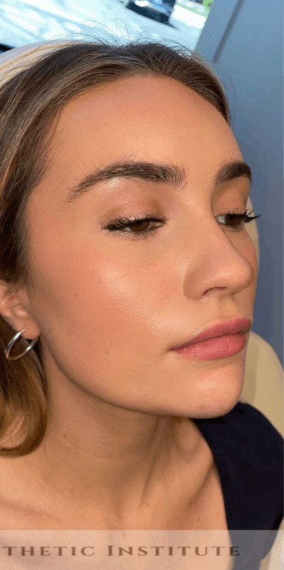Chin Filler Before & After Gallery - Patient 428654 - Image 2