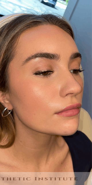 Chin Filler Before & After Gallery - Patient 428654 - Image 2