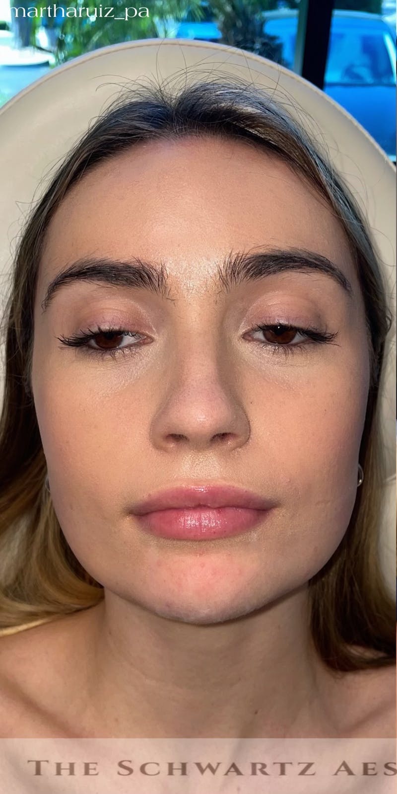 Chin Filler Before & After Gallery - Patient 428654 - Image 3