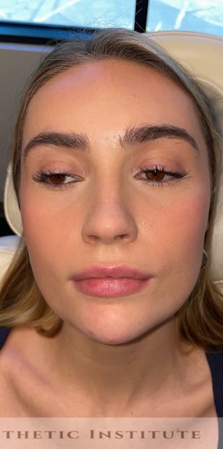 Chin Filler Before & After Gallery - Patient 428654 - Image 4