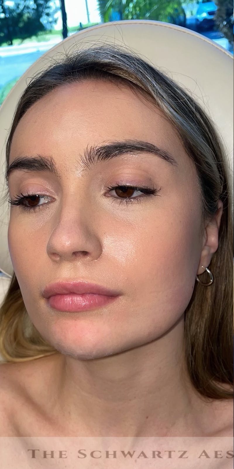 Chin Filler Before & After Gallery - Patient 428654 - Image 5