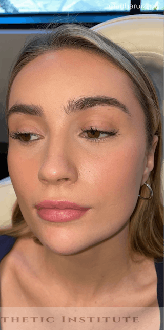 Chin Filler Before & After Gallery - Patient 428654 - Image 6