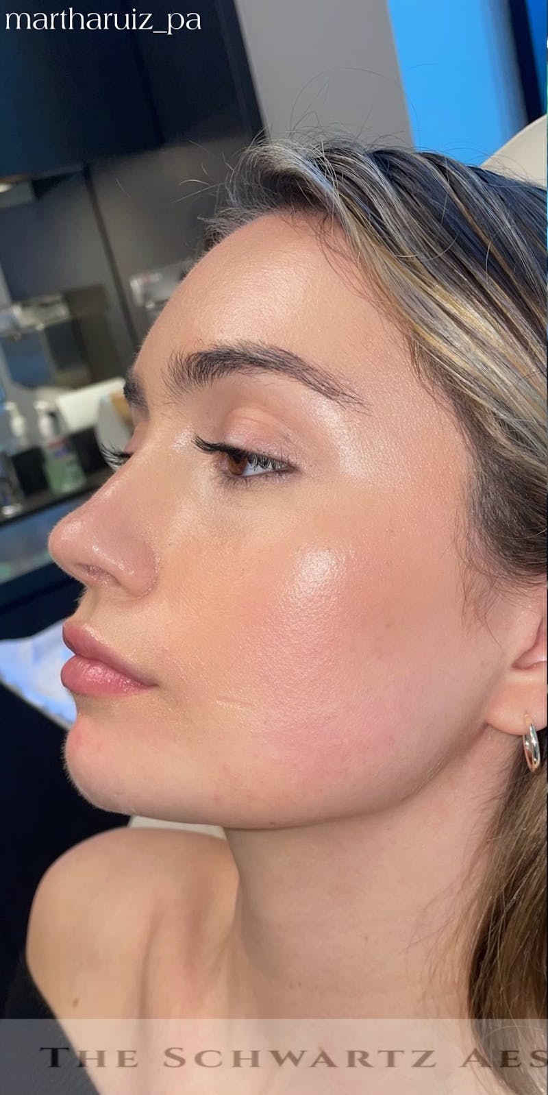 Chin Filler Before & After Gallery - Patient 428654 - Image 7