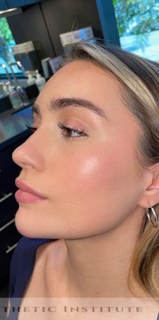 Chin Filler Before & After Gallery - Patient 428654 - Image 8