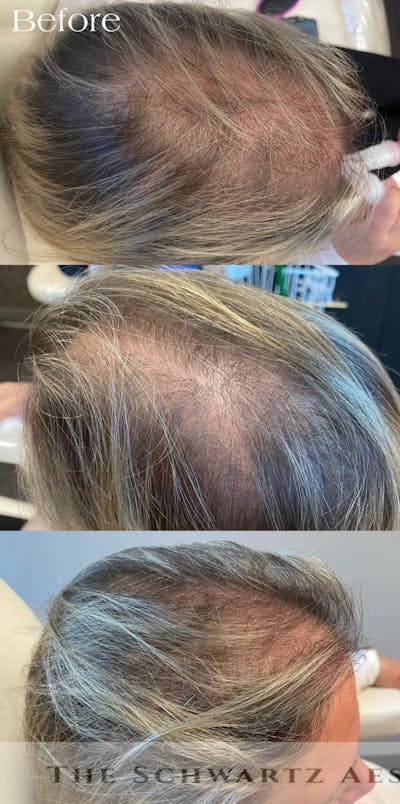 PRP Hair Restoration Before & After Gallery - Patient 158158 - Image 1