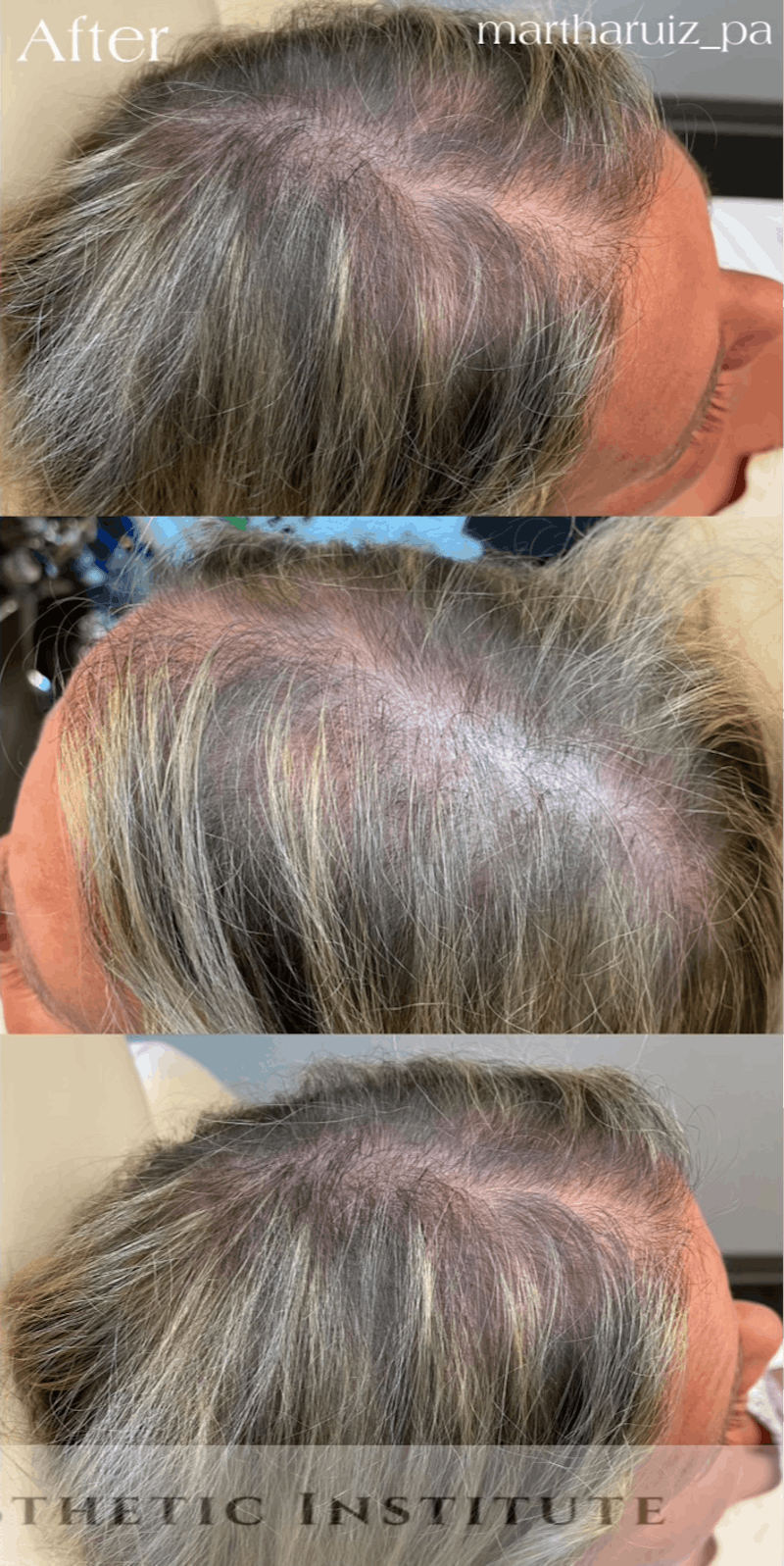 PRP Hair Restoration Before & After Gallery - Patient 158158 - Image 2