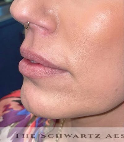 Lip Enhancement Before & After Gallery - Patient 261361 - Image 1