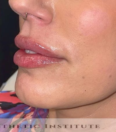 Lip Enhancement Before & After Gallery - Patient 261361 - Image 2
