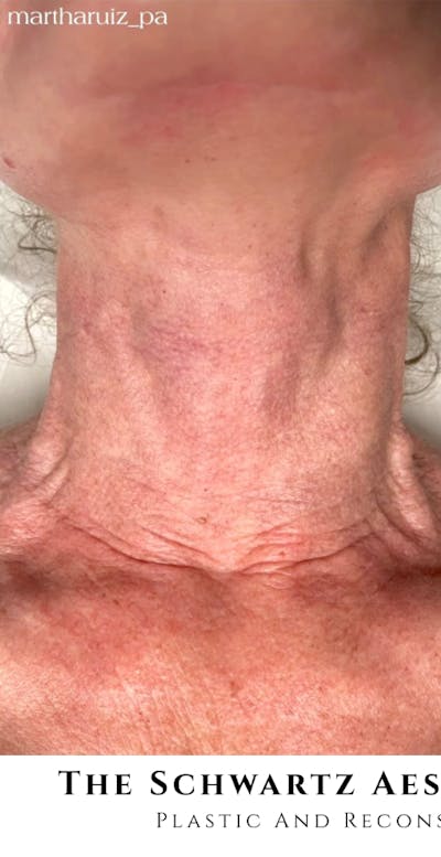 Halo Laser Before & After Gallery - Patient 399734 - Image 1