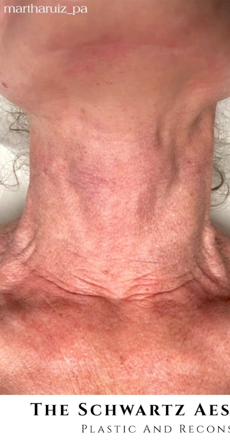 Halo Laser Before & After Gallery - Patient 399734 - Image 1