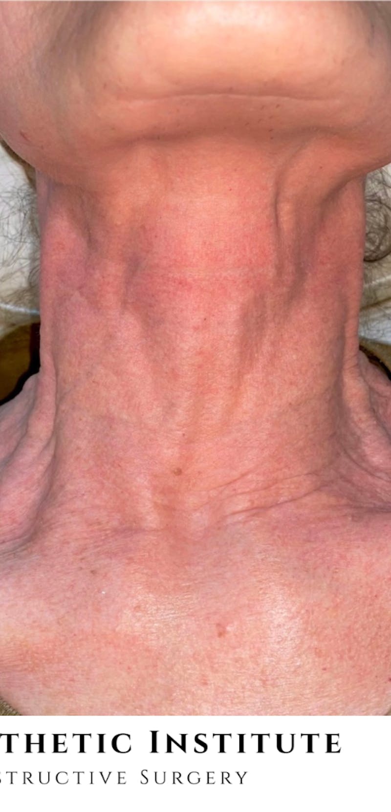 Halo Laser Before & After Gallery - Patient 399734 - Image 2