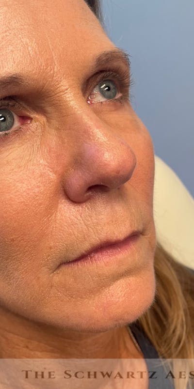 Lip Enhancement Before & After Gallery - Patient 734539 - Image 1