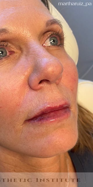 Lip Enhancement Before & After Gallery - Patient 734539 - Image 2