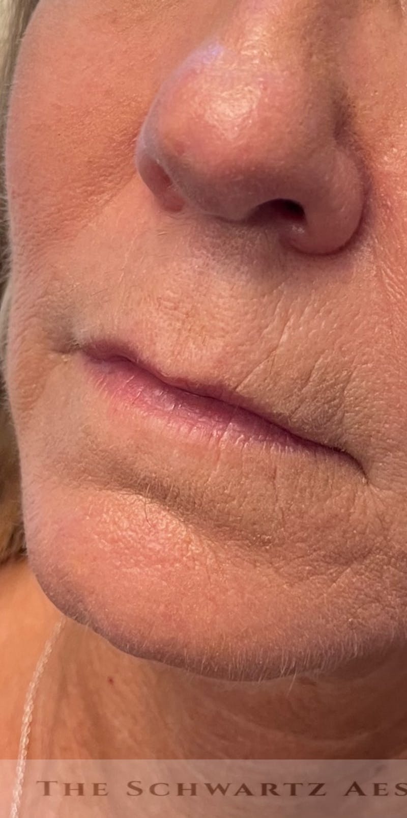 Lip Enhancement Before & After Gallery - Patient 734539 - Image 3
