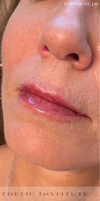 Lip Enhancement Before & After Gallery - Patient 734539 - Image 4