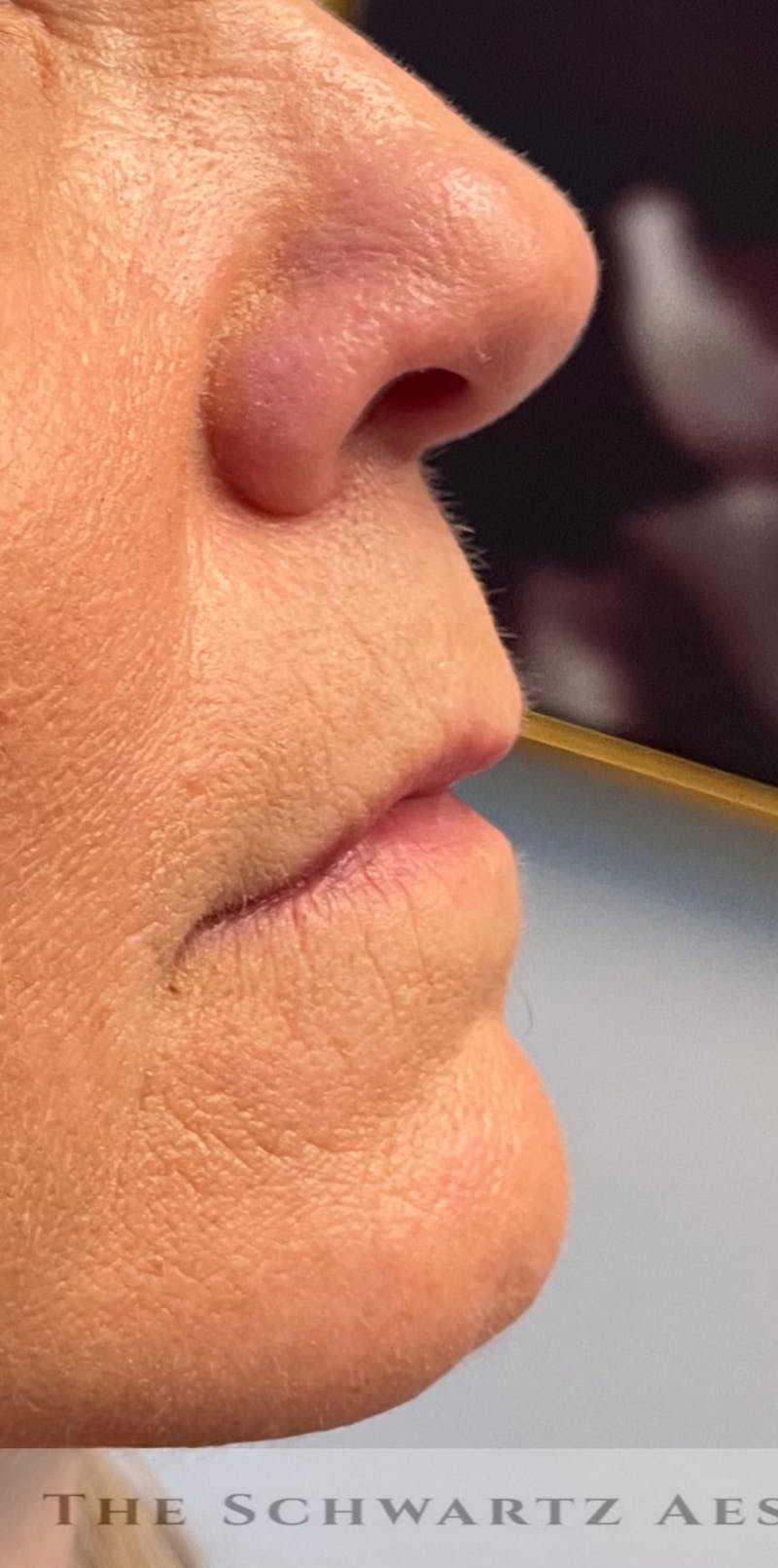 Lip Enhancement Before & After Gallery - Patient 734539 - Image 5