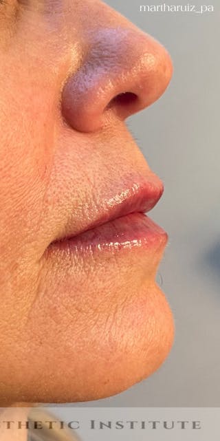 Lip Enhancement Before & After Gallery - Patient 734539 - Image 6