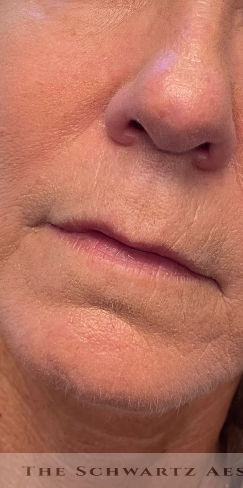 Lip Enhancement Before & After Gallery - Patient 734539 - Image 7