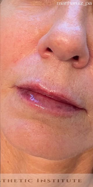Lip Enhancement Before & After Gallery - Patient 734539 - Image 8