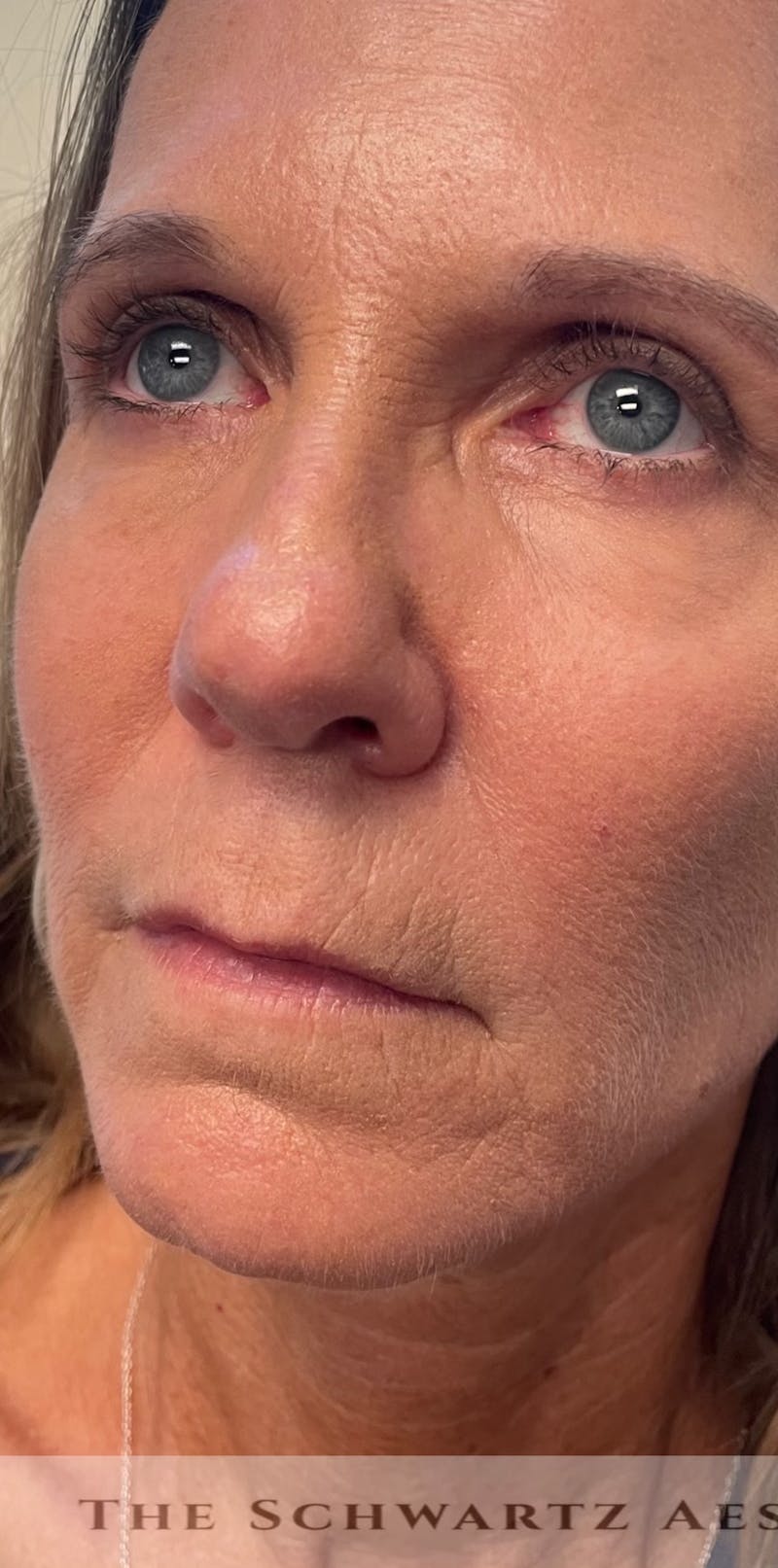 Lip Enhancement Before & After Gallery - Patient 734539 - Image 9