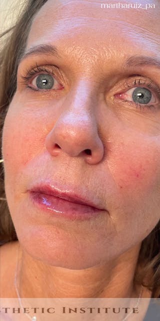 Lip Enhancement Before & After Gallery - Patient 734539 - Image 10