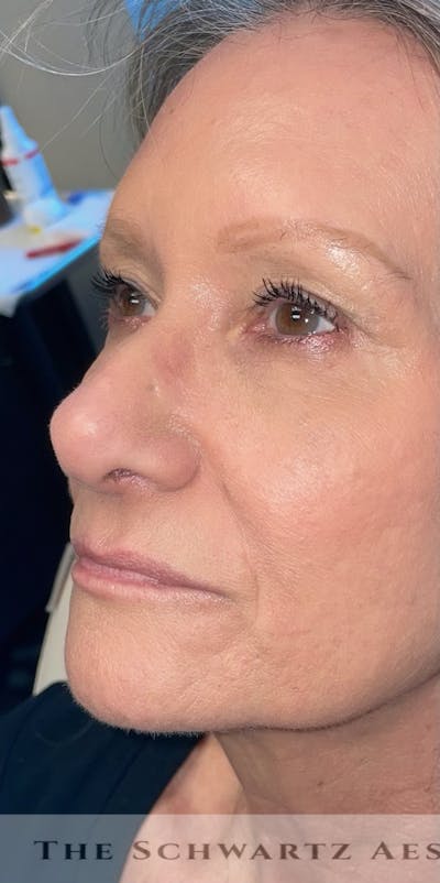 Lip Enhancement Before & After Gallery - Patient 318030 - Image 1