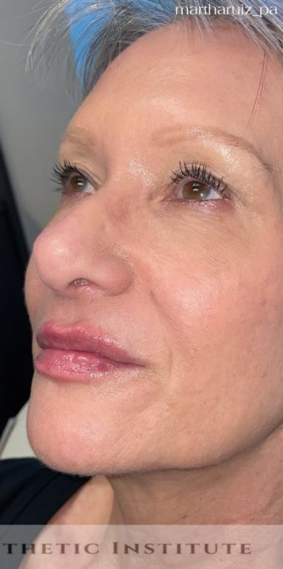 Lip Enhancement Before & After Gallery - Patient 318030 - Image 2