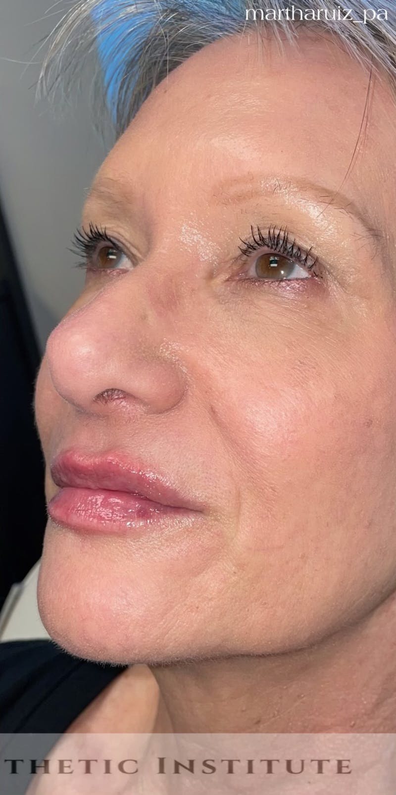 Lip Enhancement Before & After Gallery - Patient 318030 - Image 2
