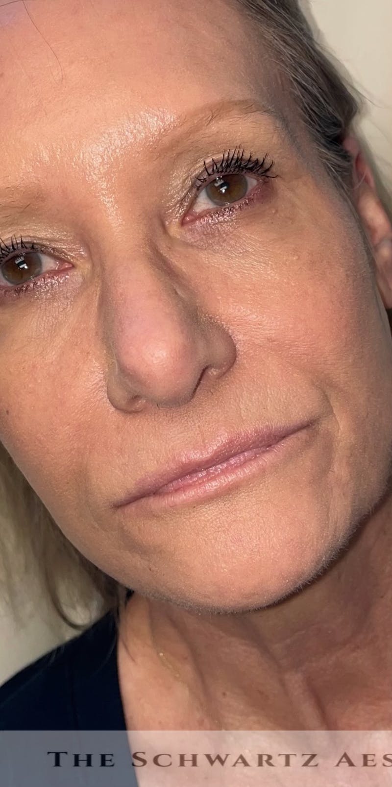 Lip Enhancement Before & After Gallery - Patient 318030 - Image 3