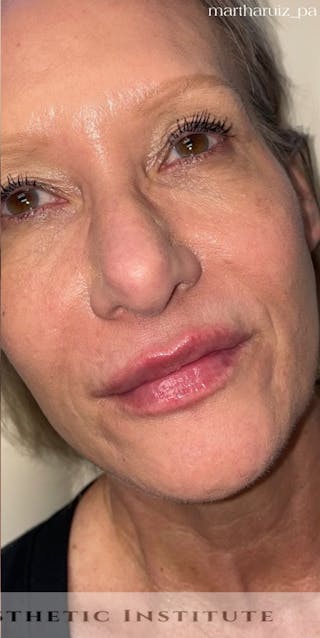 Lip Enhancement Before & After Gallery - Patient 318030 - Image 4