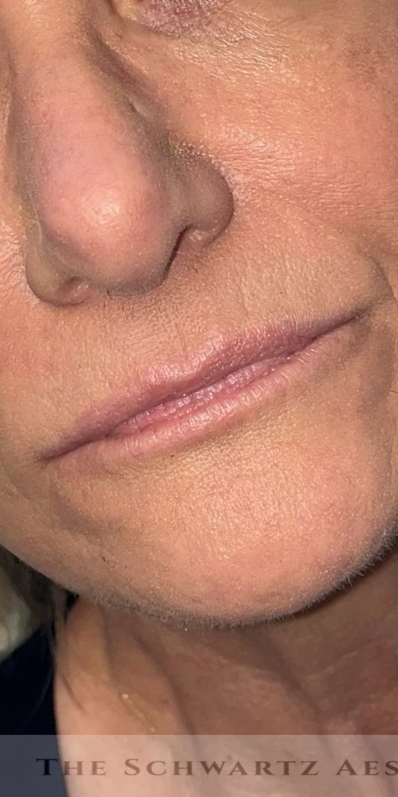 Lip Enhancement Before & After Gallery - Patient 318030 - Image 5