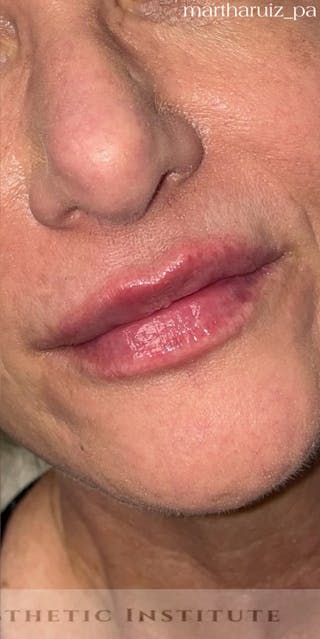 Lip Enhancement Before & After Gallery - Patient 318030 - Image 6
