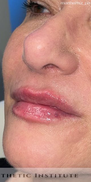 Lip Enhancement Before & After Gallery - Patient 318030 - Image 8