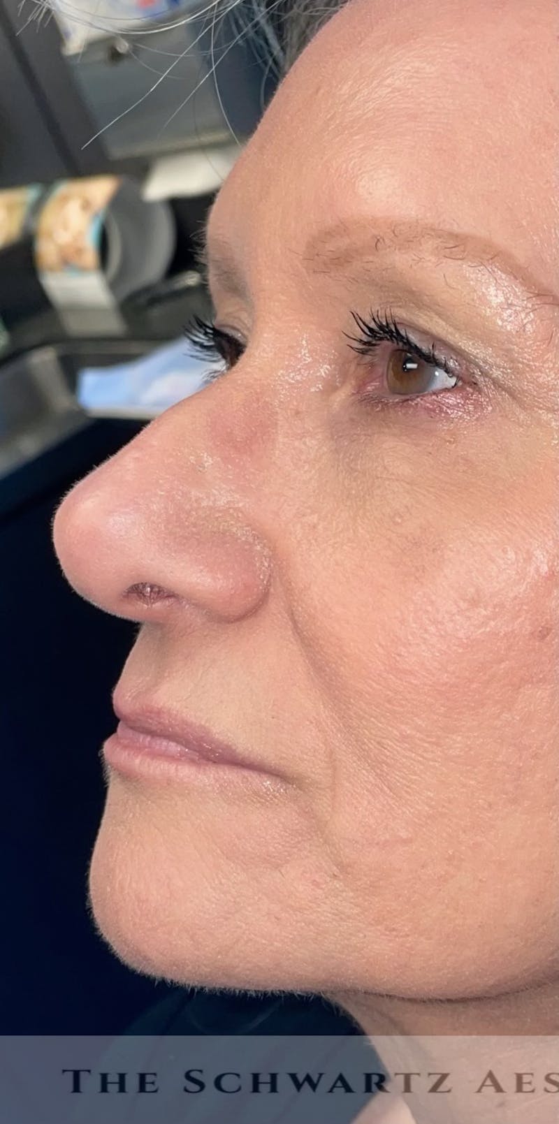 Lip Enhancement Before & After Gallery - Patient 318030 - Image 9