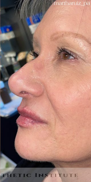 Lip Enhancement Before & After Gallery - Patient 318030 - Image 10